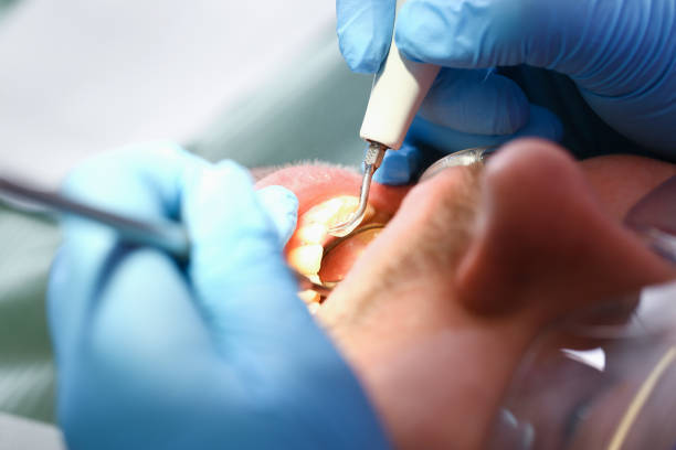 Best Emergency Tooth Extraction in Muttontown, NY
